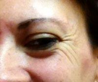 A Good Wrinkle Filler For Crows Feet