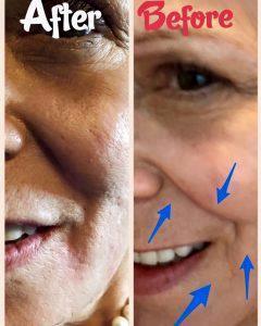 Acne Scar Correction And Reduction In Smile Lines Accomplished With Juvederm At Flawless Fillers In Austin