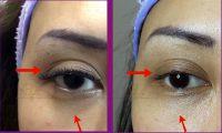 An Experienced Professional Can Help To Minimize The Likelihood Of Eyelid Drooping