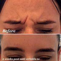 And 2 Weeks Post Anto Wrinkle Treatment