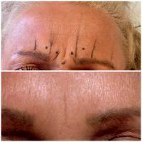 Anto Wrinkle Treatment On Glabella