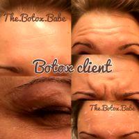 BOTOX Can Be Used Very Effectively