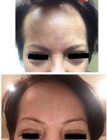 BOTOX To Relax The Muscles And A Filler To Correct The Static Lines