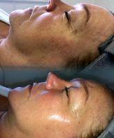 BOTOX Used In Many Areas Of Face