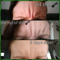 Before And 3 Days After Injection In Glabella