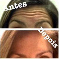 Before And After Botox In Forehead Results