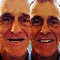 Before And After Botox Injections For Men