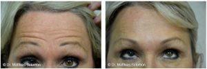 Before And After Botox To The Glabella, Forehead And Brow Muscles By Matthias Solomon, MD, Dallas Plastic Surgeon