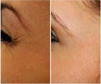 Before And After Crows Feet At 24