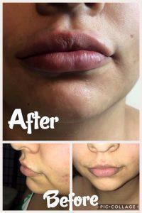 Before And After Juvederm Lips At Flawless Fillers In Austin