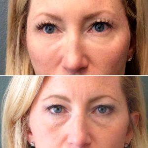 Before And After Juvederm Voluma Treatment Under The Eyes At Institute Of Anti-Aging Medicine And Skin Spa