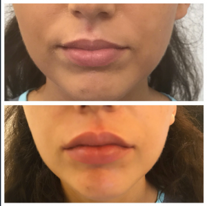 Before And After Lip Fillers With Juvederm To Define And Plump The Lips At Glo Medspa, Medical Spa In Scottsdale, Arizona