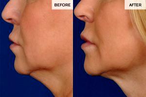 Before And After Photos Of Kybella Injections By Dr. David Broadway, Denver Plastic Surgeon