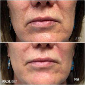 Before And After Photos Of Nasolabial Folds And Above The Chin Using 1 Syringe Of Juvederm By Scottsdale Plastic Surgeon, Dr. John J. Corey, MD