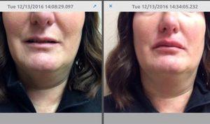 Before And After With Restylane In The Lips At Universal Dermatology & Vein Care In Dublin Ohio
