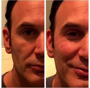 Before And After With Voluma XC At Skin Deep Laser Services In Boston