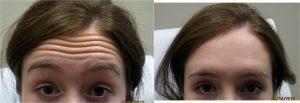 Before And Two Weeks After Botox Treatment By Dr. Tricia Brown, Dermatologist In Houston, TX