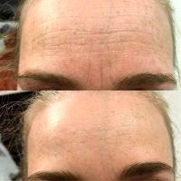 Belatero In Conjunction With BOTOX For Treating Lines And Creases