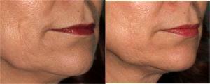 Bellafill Injection to Right Side Only by Dr. Otto J. Placik, Chicago Plastic Surgeon (1)
