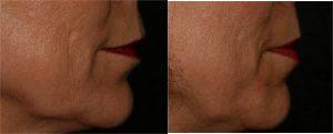 Bellafill Injection to Right Side Only by Dr. Otto J. Placik, Chicago Plastic Surgeon (2)