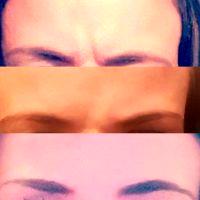 Best Place For Botox Brow Lift