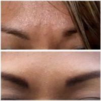 Botox 11 Lines Before After