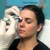 Botox Alternatives For Smoothing Wrinkles