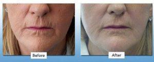 Botox And Juvederm For Smooth Perioral Wrinkles By Dr. Christine Hamori, Plastic Surgeon In Duxbury, MA
