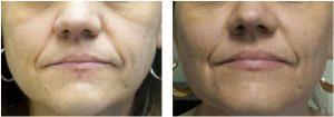 Botox And Radiesse By Dr. Christine Hamori, Plastic Surgeon In Duxbury, MA