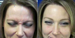 Botox And Restylane By Doctor Anthony Corrado, DO, Philadelphia Facial Plastic Surgeon