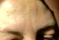 Botox And Wrinkles In Forehead And Glabella