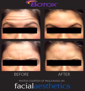 Botox At Facial Aesthetics In Denver
