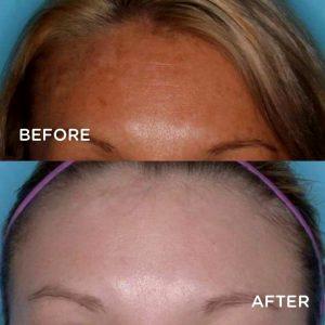 Botox At Timeless Skin Solutions, Skin Care Clinic In Dublin, Ohio