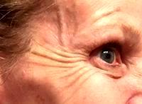 Botox Avoiding Droopy Eye
