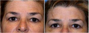 Botox Before And After At Allure Plastic Surgery, Miami FL (1)