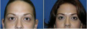 Botox Before And After At Allure Plastic Surgery, Miami FL (2)