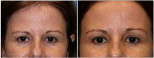 Botox Before And After At Allure Plastic Surgery, Miami FL (3)