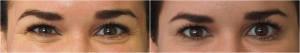 Botox Before And After At Skin By Lovely, Portland OR (1)
