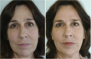 Botox Before And After At Skin By Lovely, Portland OR (2)