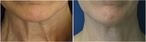 Botox Before And After At Skin By Lovely, Portland OR (3)