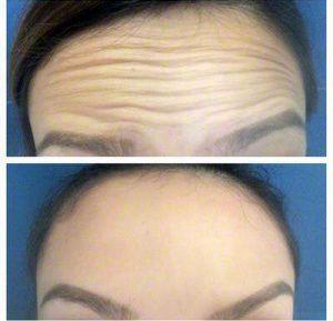 Botox Before And After At Skintastic Cosmetic Surgery And Laser Skincare Centers In Dallas