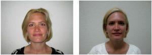 Botox Before And After By By Clayton Frenzel, Doctor In Arlington, Texas