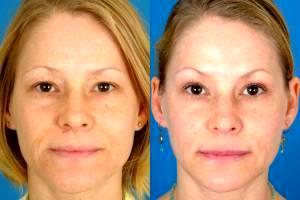 Botox Before And After By By Dr. Benjamin Bassichis, Dallas Plastic Surgeon