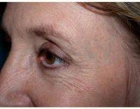 Botox Before And After By Doctor Suzanne M. Quardt, MD, Palm Springs Plastic Surgeon