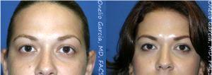 Botox Before And After By Dr Onelio Garcia Jr., M.D., Plastic Surgeon In Miami, Florida (1)