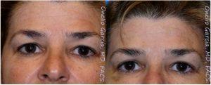 Botox Before And After By Dr Onelio Garcia Jr., M.D., Plastic Surgeon In Miami, Florida (2)