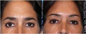 Botox Before And After By Dr Onelio Garcia Jr., M.D., Plastic Surgeon In Miami, Florida (3)