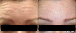 Botox Before And After By Dr Roy Kim, MD, San Francisco Plastic Surgeon