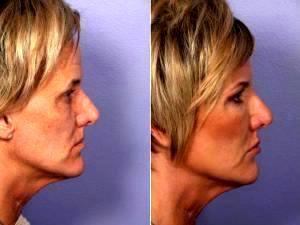 Botox Before And After By Dr. Grant Stevens, MD, Los Angeles Plastic Surgeon