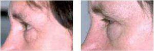 Botox Before And After By Dr. Surjit S. Rai, MD, Dallas TX Physician (1)